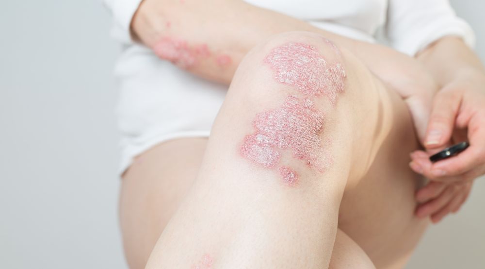 Black Cumin: The Natural Support Your Psoriasis or Dermatitis-Prone Skin Needs